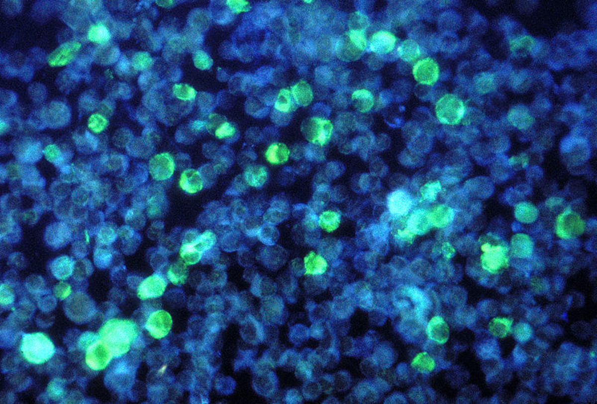 Leukemia cells that contain Epstein Barrvirus using a FA staining technique