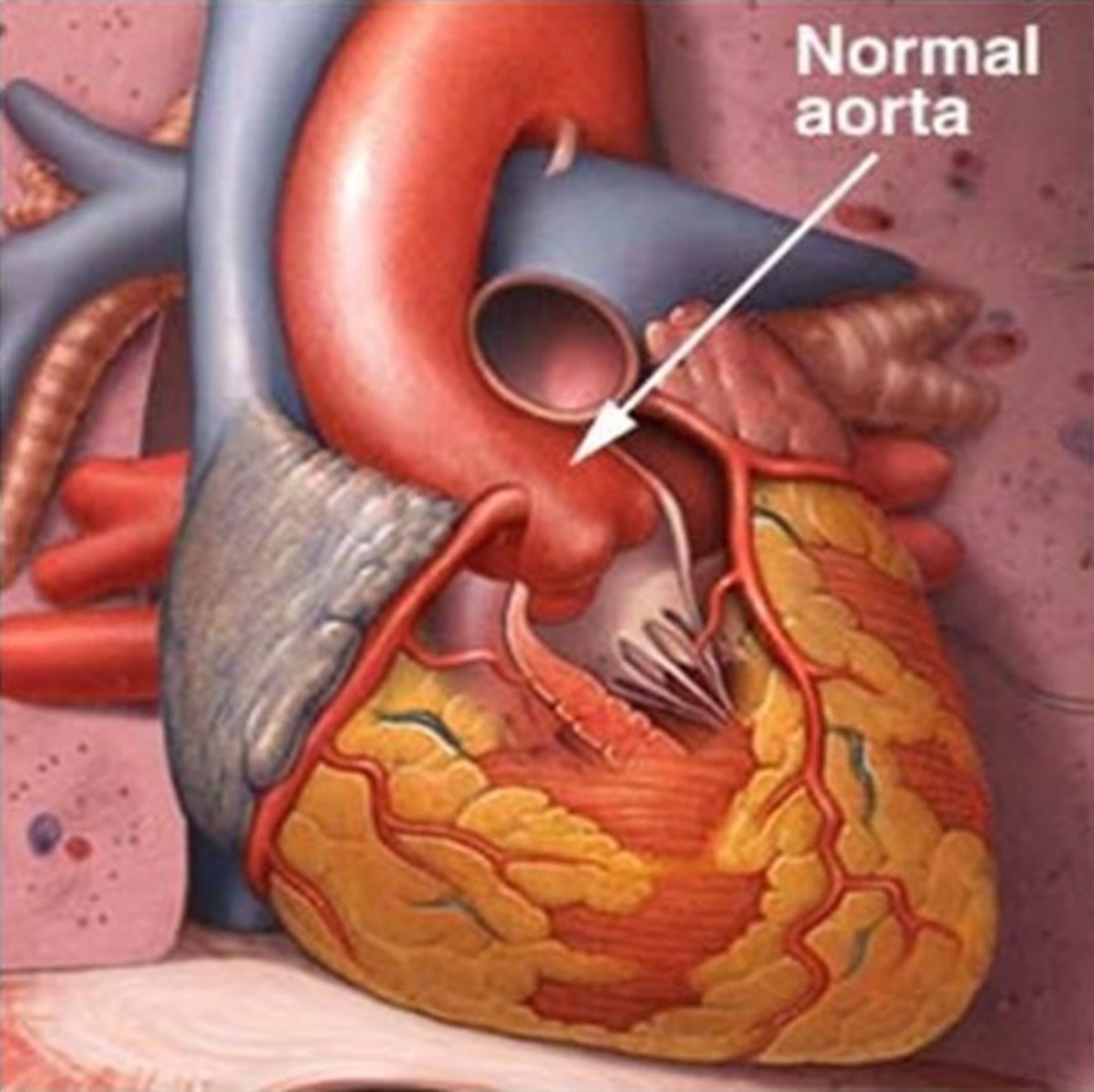 enlarged-aorta