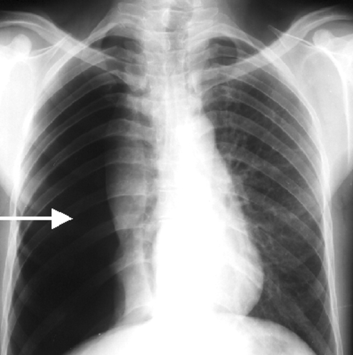 Разрыв легочной. Пневмоторакс рентгенография. Пневмоторакс рентген. Спонтанный пневмоторакс рентген. Рентгенография грудной клетки пневмоторакс.
