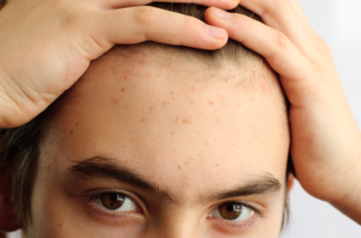 6 Easy Ways to Prevent Forehead Acne