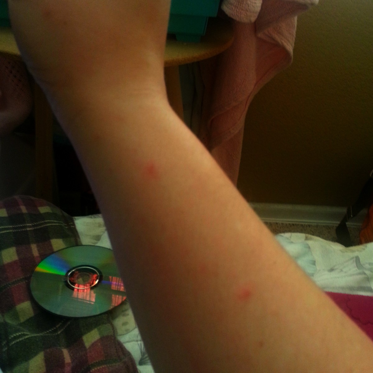 This is my arm during a minor eczema breakout