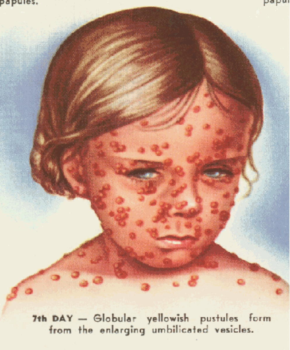 Child with smallpox
