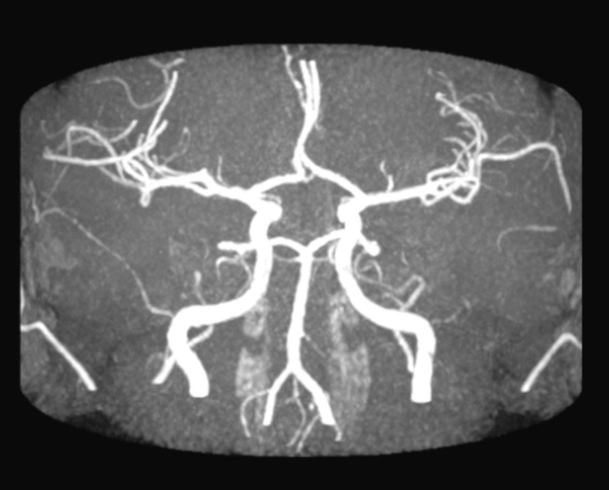 The Brain S Plan B For Stroke The Circle Of Willis Hubpages