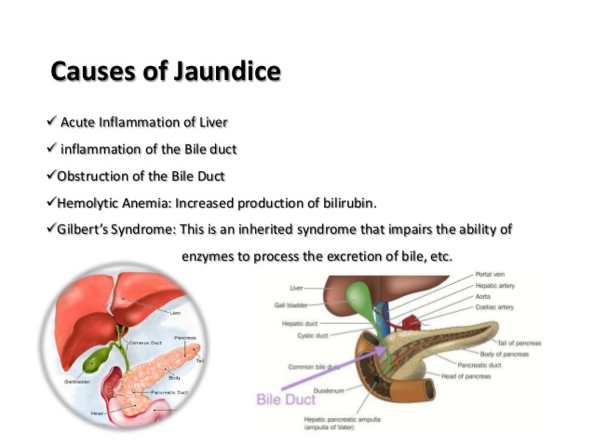 Cause of Jaundice 