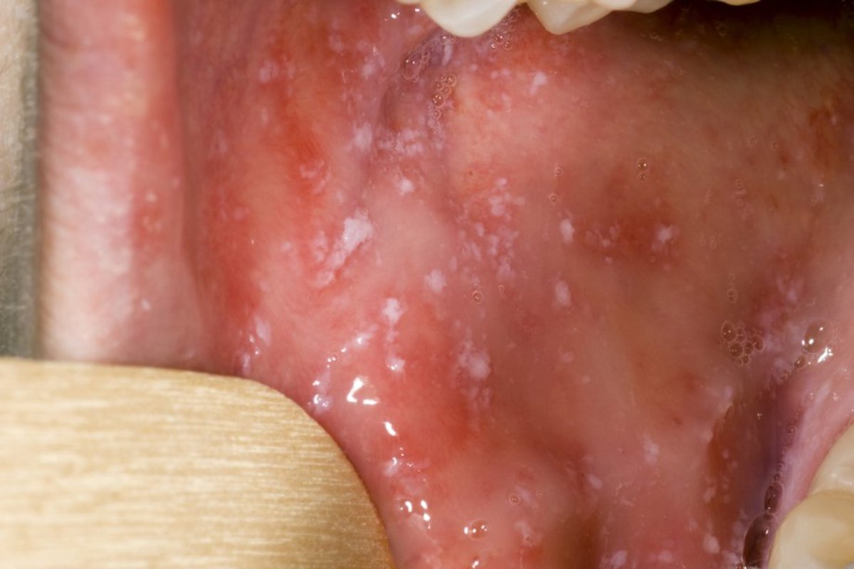 White spots in the mouth from measles. 