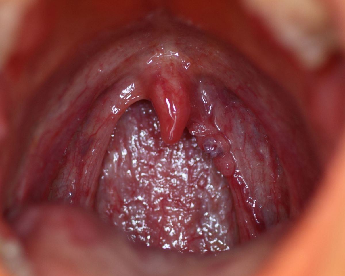 infection in papilloma