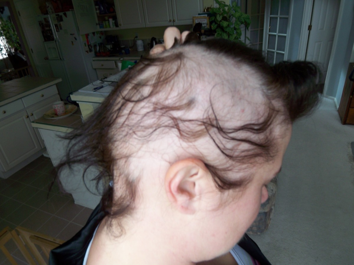 A severe case of alopecia areata