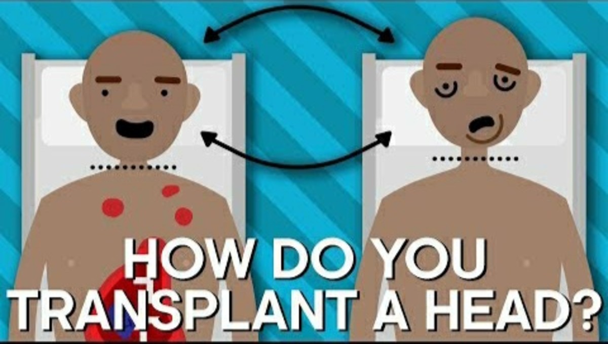 How Do You Transplant A Human Head?