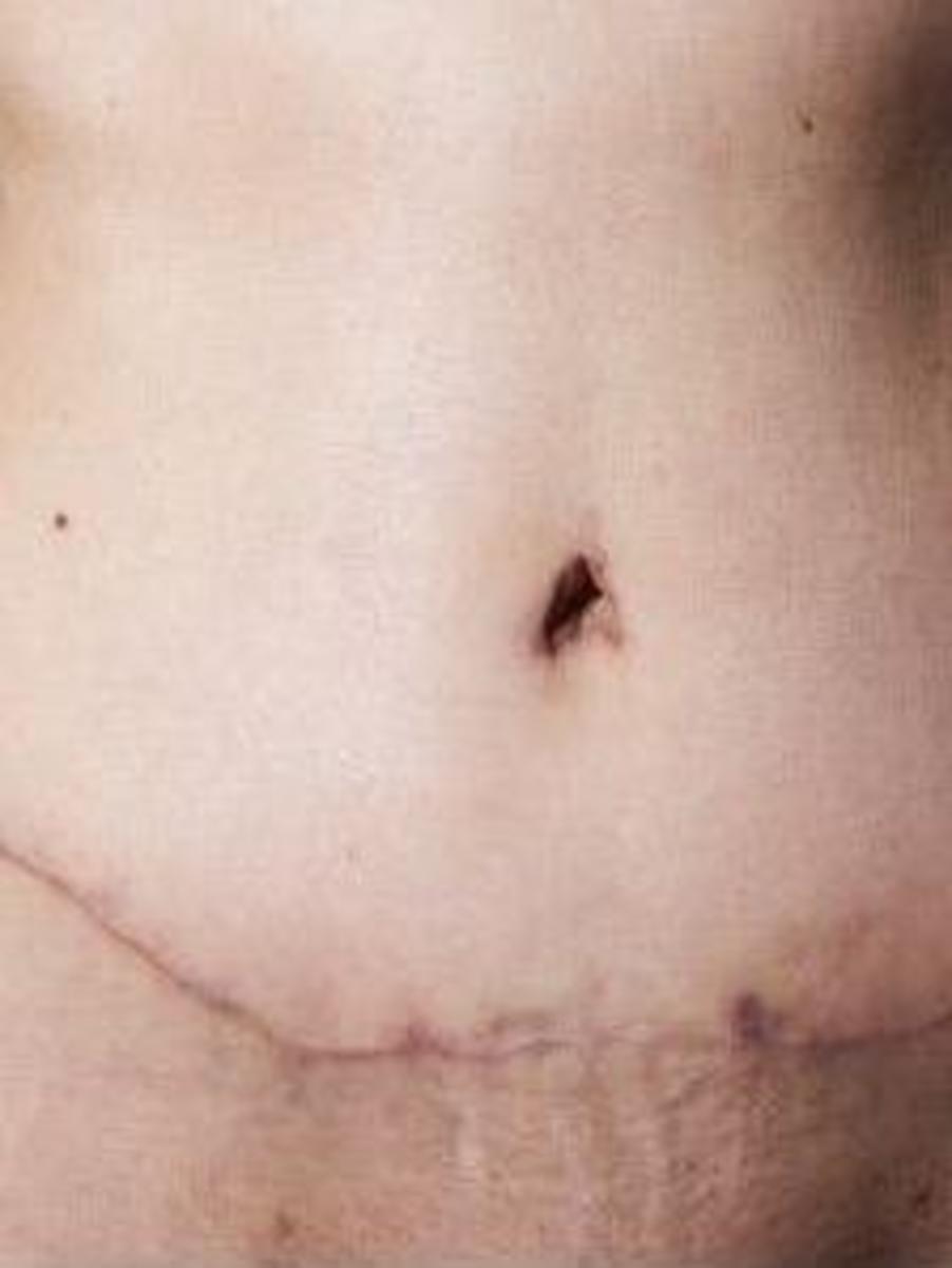Tummy Tuck Scars-How to Reduce and Conceal the Appearance of a Tummy Tuck Scar