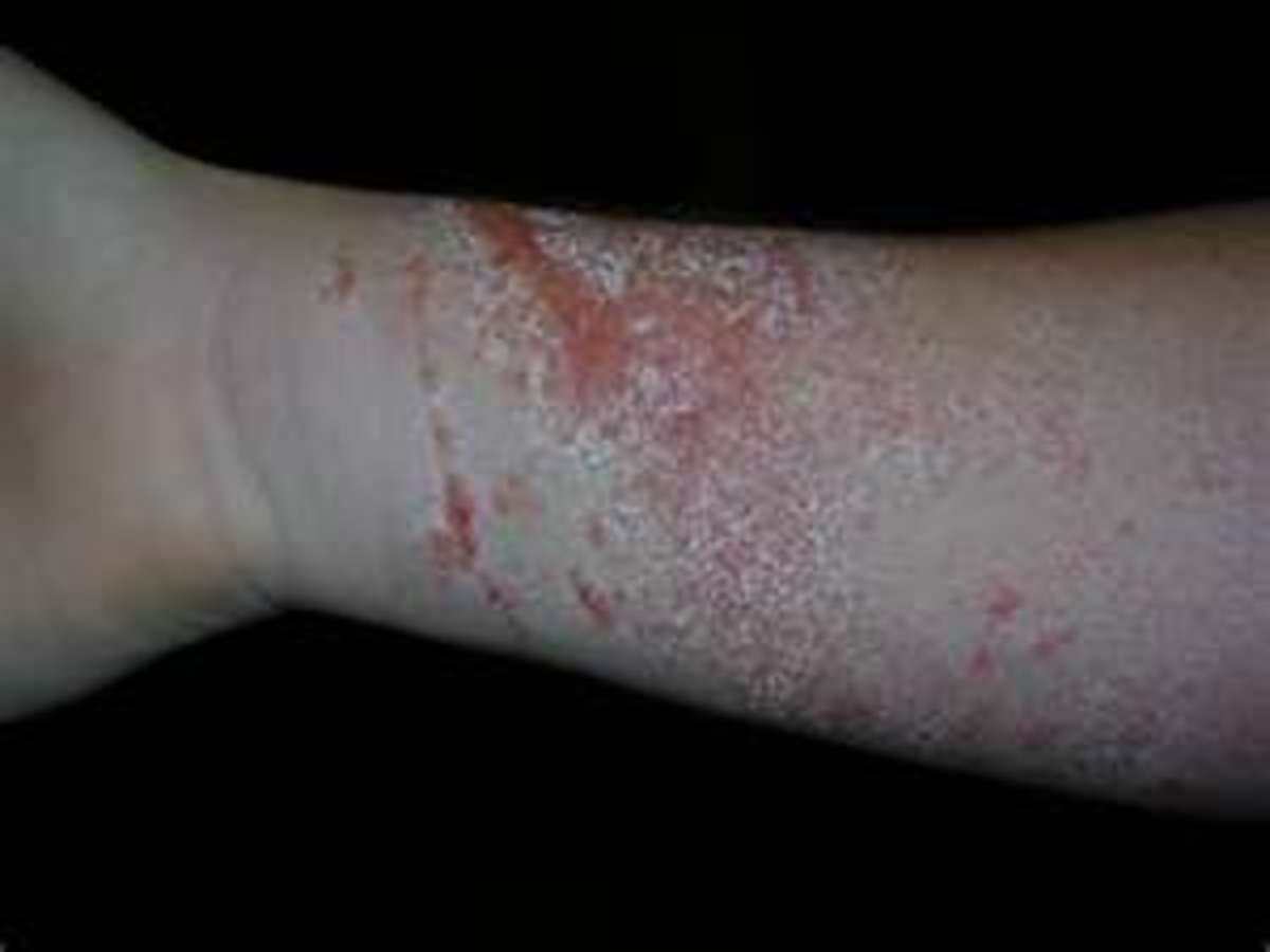 poison-oak-and-sumac-treatment-pictures-and-symptoms