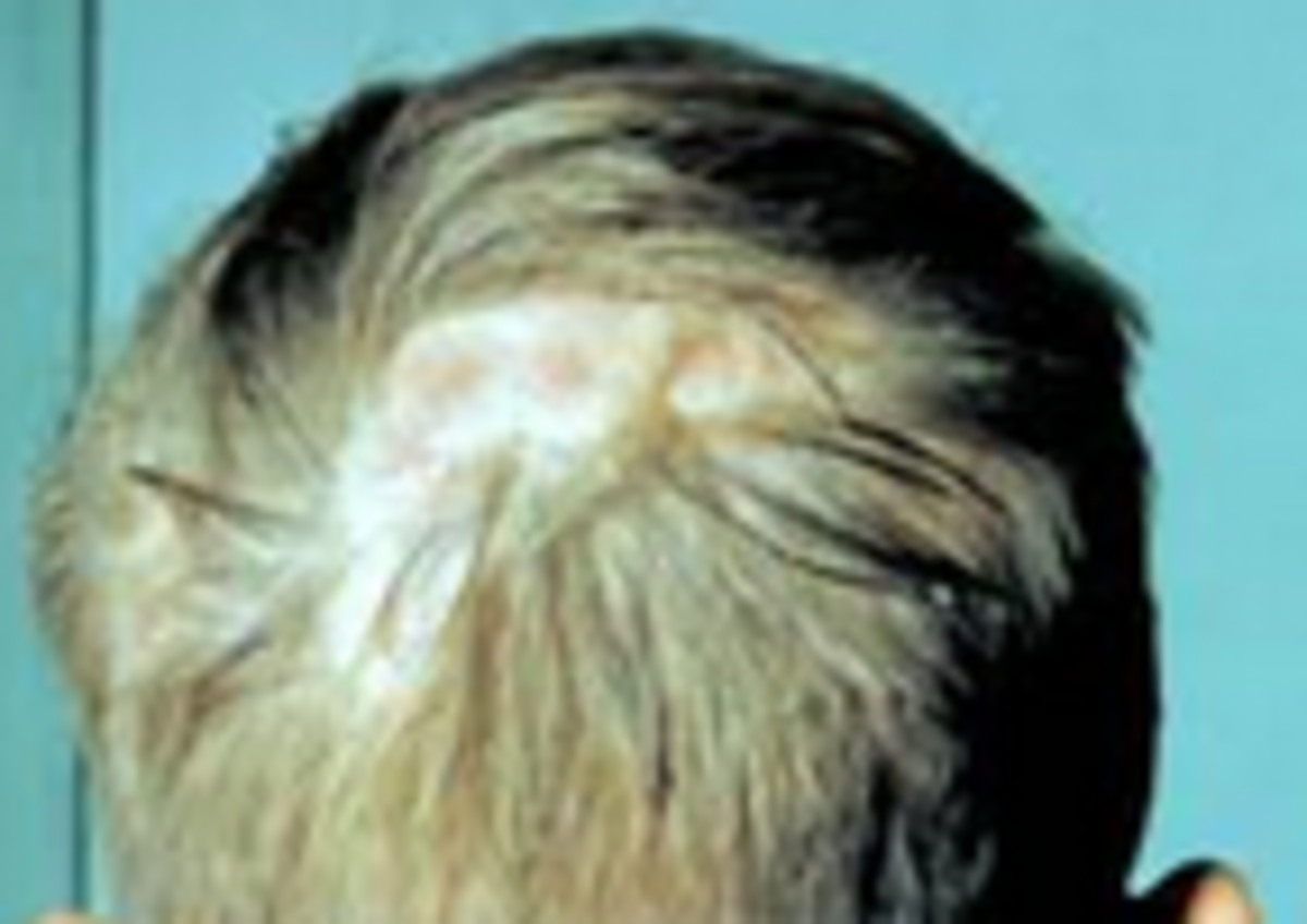 Ringworm of the scalp