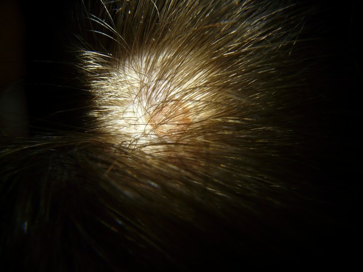 Beginning of Ringworm In The Scalp