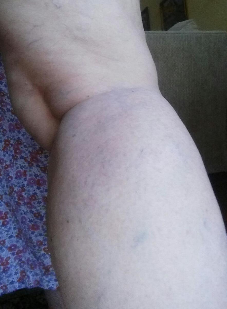 My after photo taken in September of 2017. It takes some time for everything to heal up, but once it does, you can see that the difference is pretty dramatic. I'm very happy with the treatments I had! I'm hoping these spider veins never come back.
