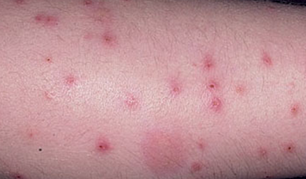 Flea Bites On Humans Symptoms Treatment Pictures YouMeMindBody