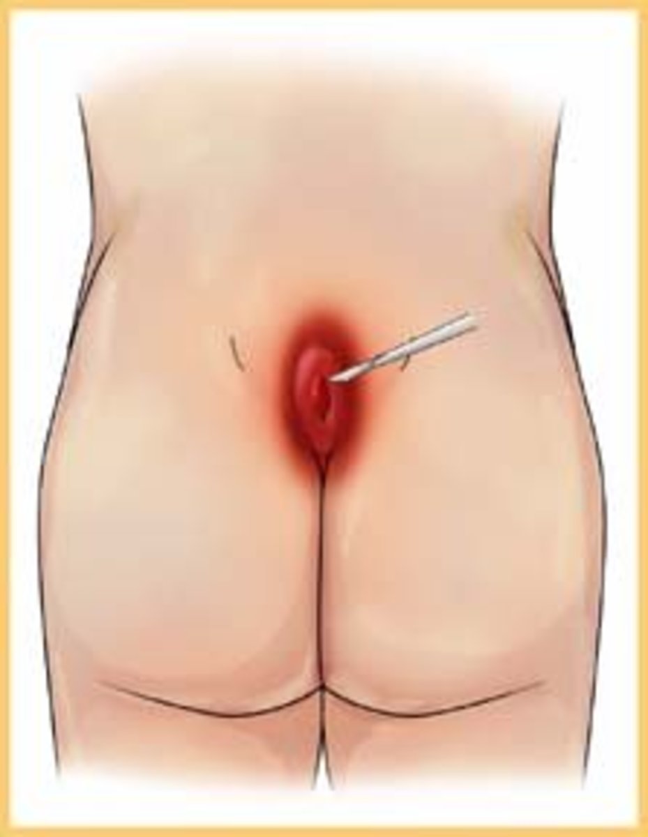 definitive-guide-to-pilonidal-cysts-part-2