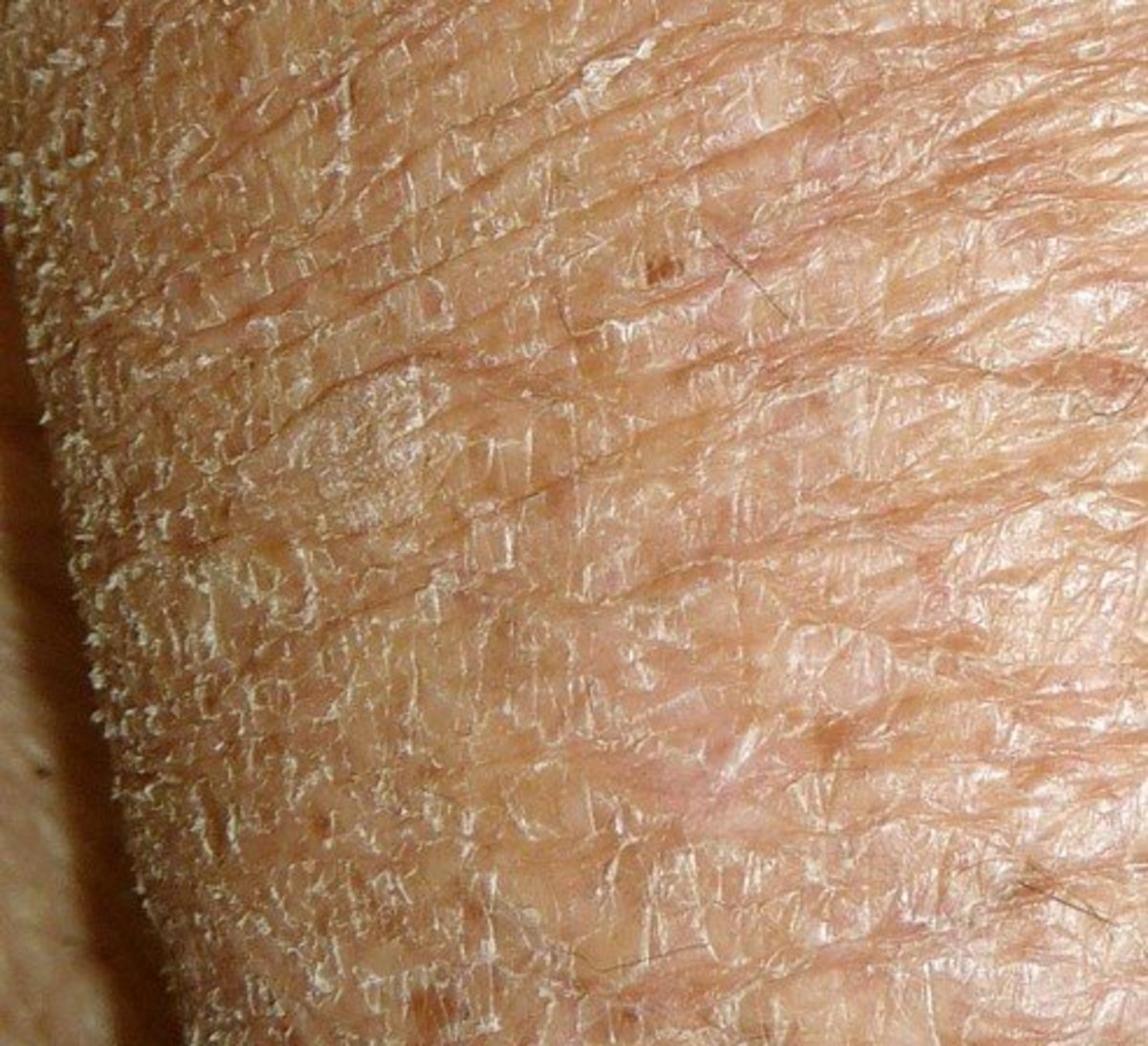 Xerosis - Definition, Pictures, Treatment, Symptoms and Causes