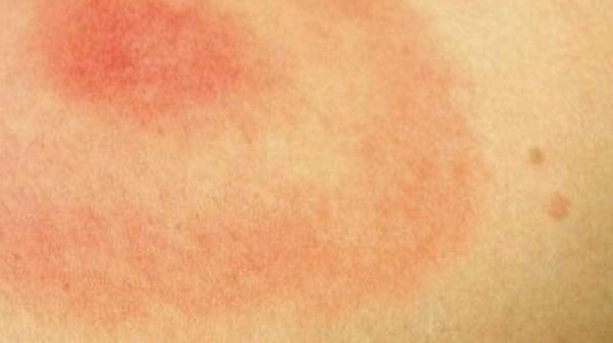 Bullseye Style Lyme Disease Rash