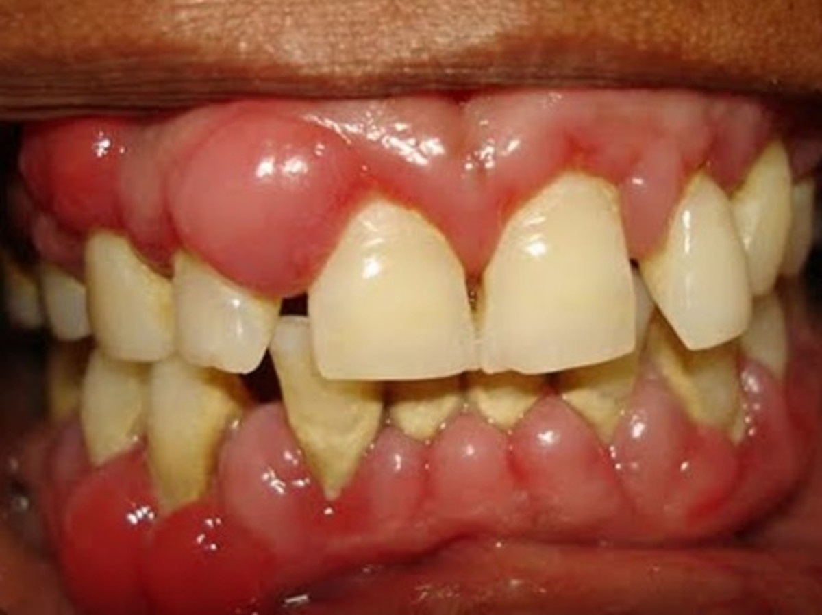 swollen-gums