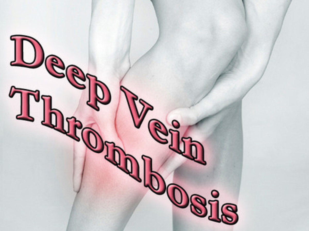 DVT - What Is A Deep Vein Thrombosis?
