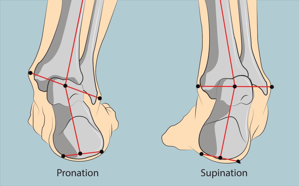 Choosing Shoes That Help with Supination