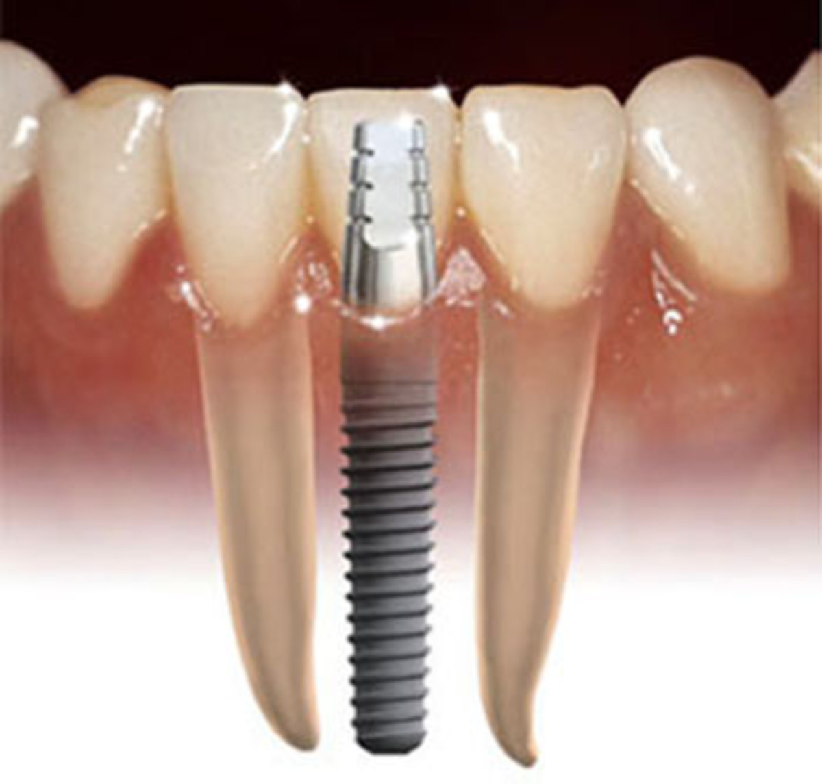 How to Get Free Dental Implants