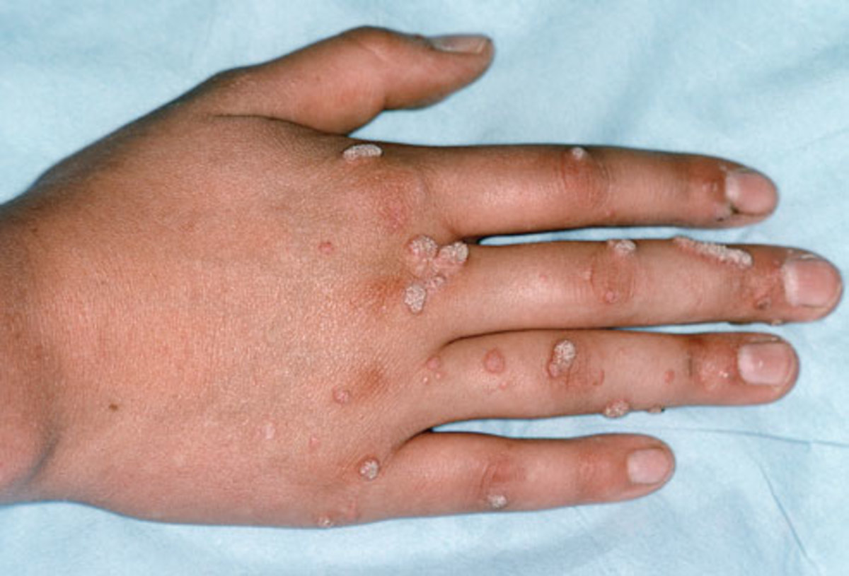 Warts On the Hands