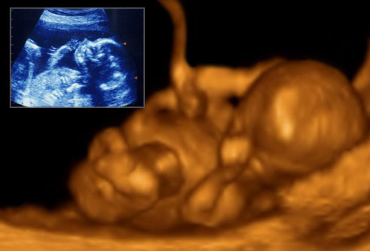 2d ultrasound contrasted with 4d ultra sound at 20 weeks baby