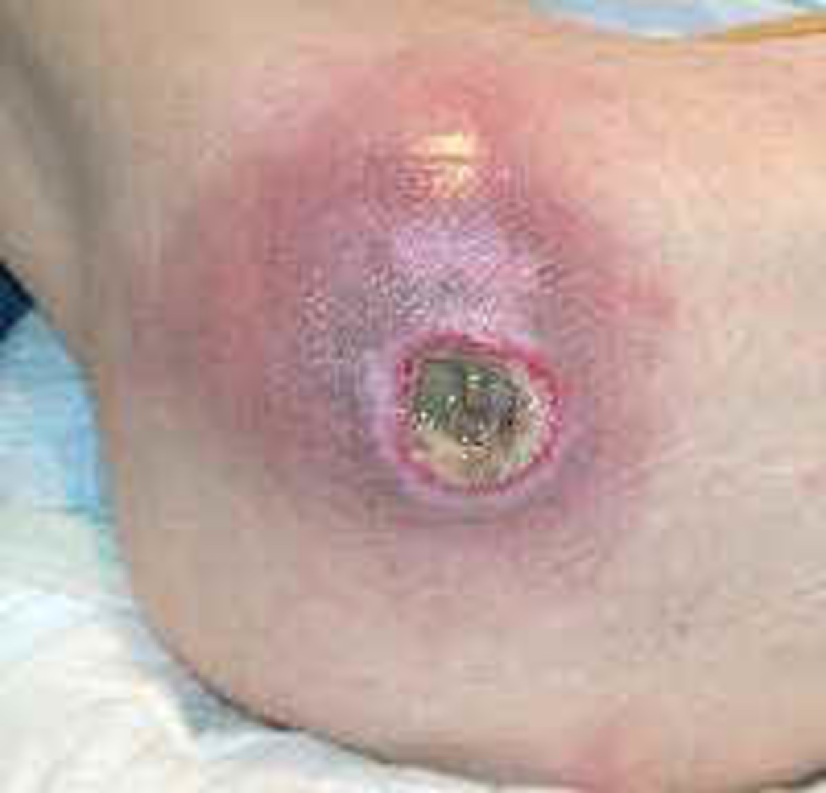 A wound infected with MRSA