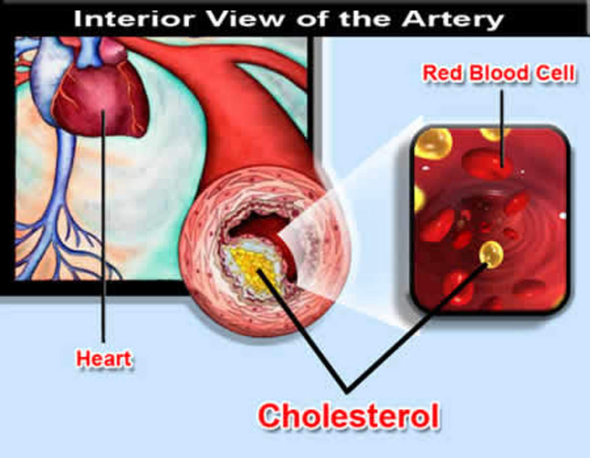 How to Lower Your Cholesterol Level Fast / Quickly - HubPages