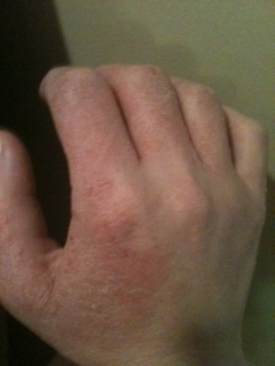dermatitis-herpetiformis-maybe-that-rash-isnt-just-eczema