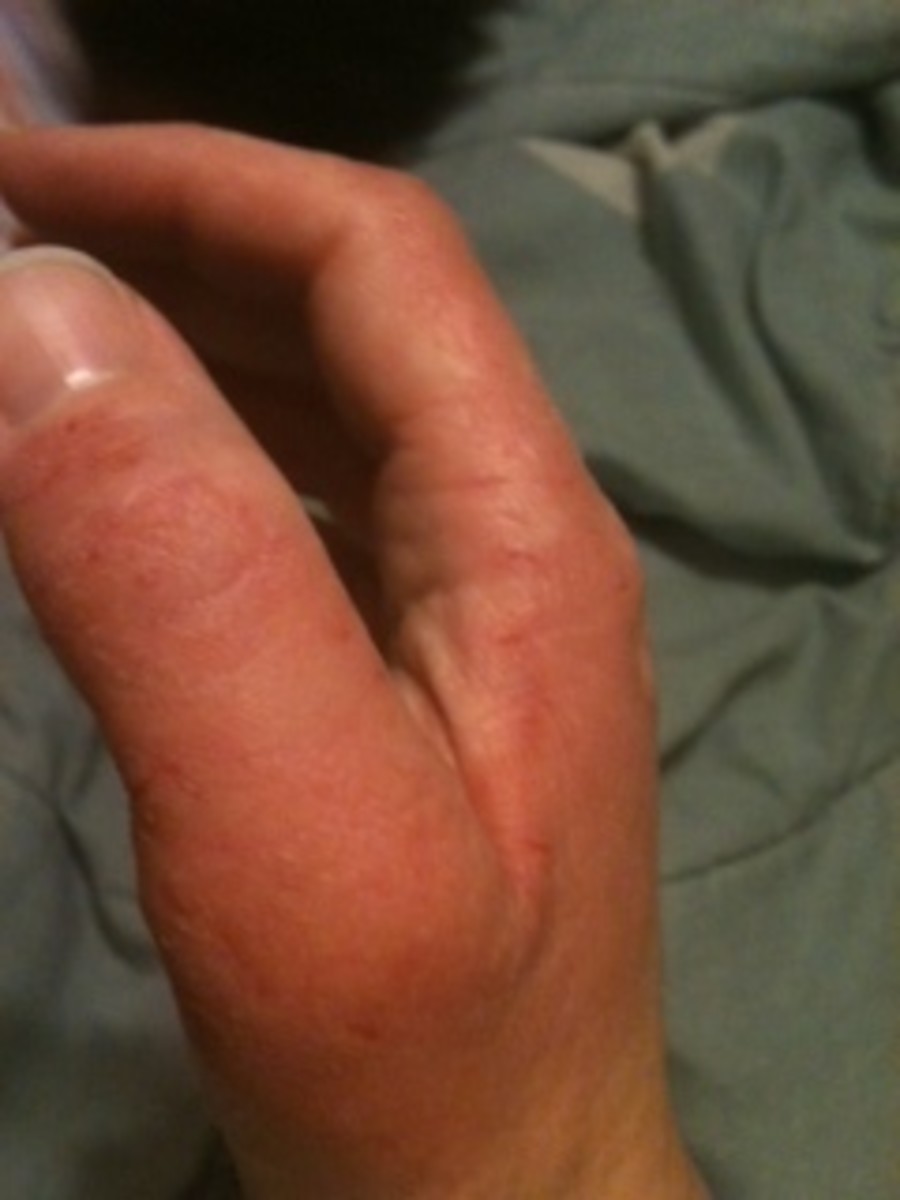 dermatitis-herpetiformis-maybe-that-rash-isnt-just-eczema
