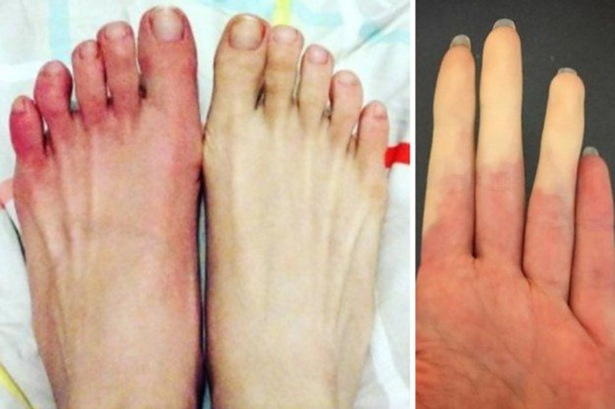 During a Raynaud's attack, the skin may appear white or blue, and then red as the body warms up again.