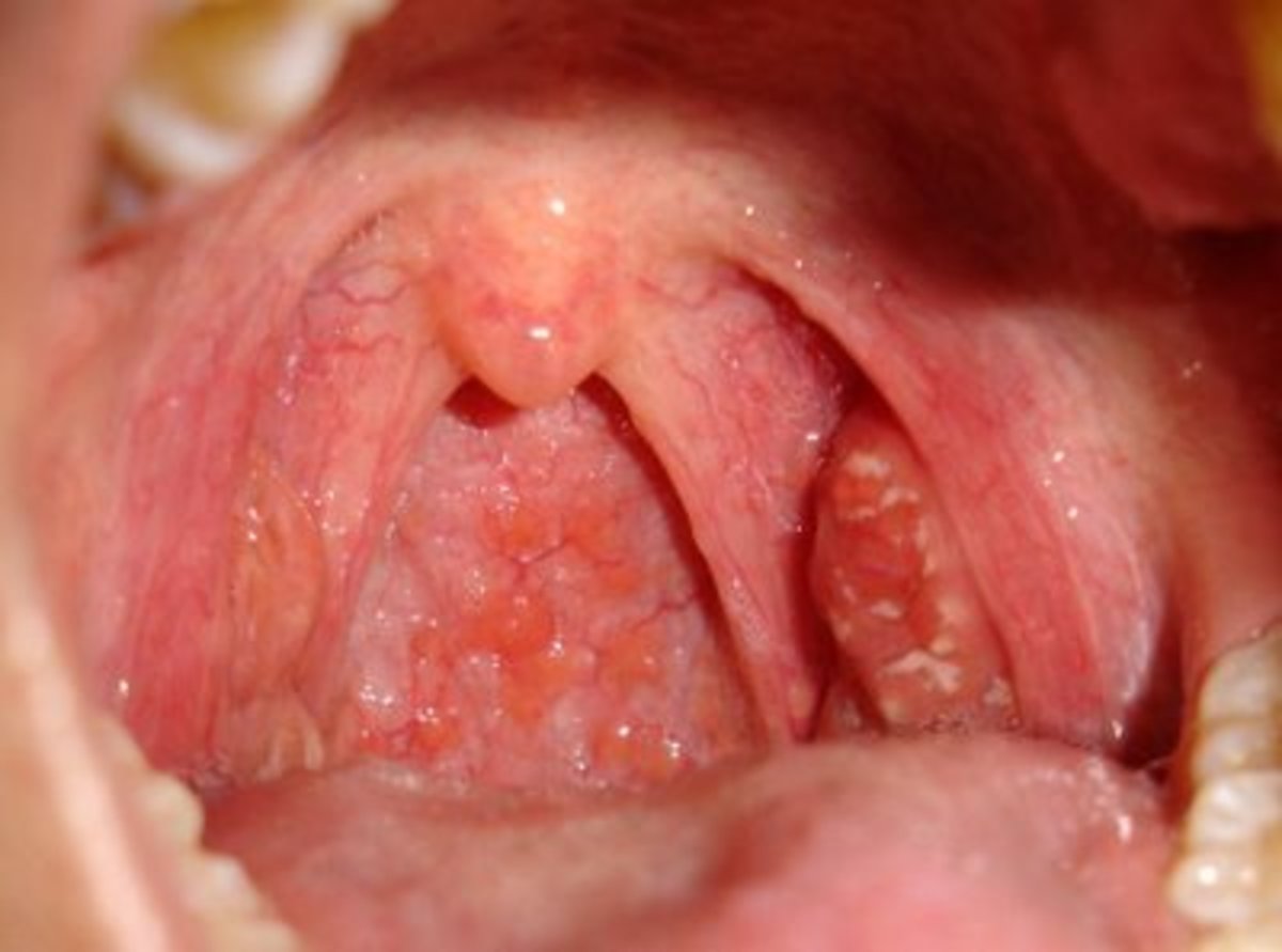 acute-tonsillitis