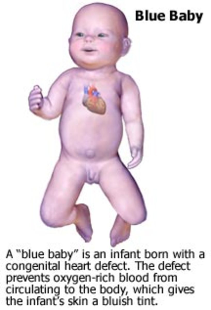 This is due to mixing of blood between two atria and the mixed blood is supplied to the body of newborn babies resulting in blueness of skin-thus the name blue babies.