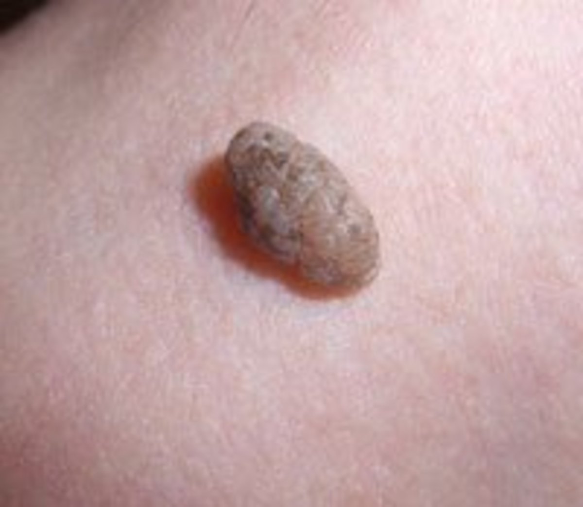 Skin tags, as the one pictured here, can be found on areas of the body where there are folds or creases. The neck, groin, armpits, and beneath the arms are a few of these more common areas