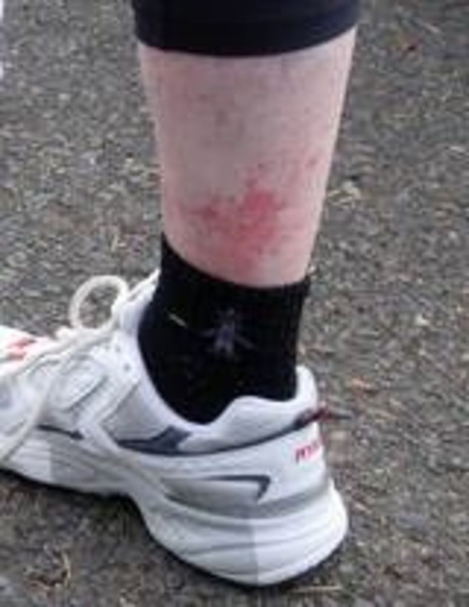 Leg Rash Begins Above The Sock Line and Spreads