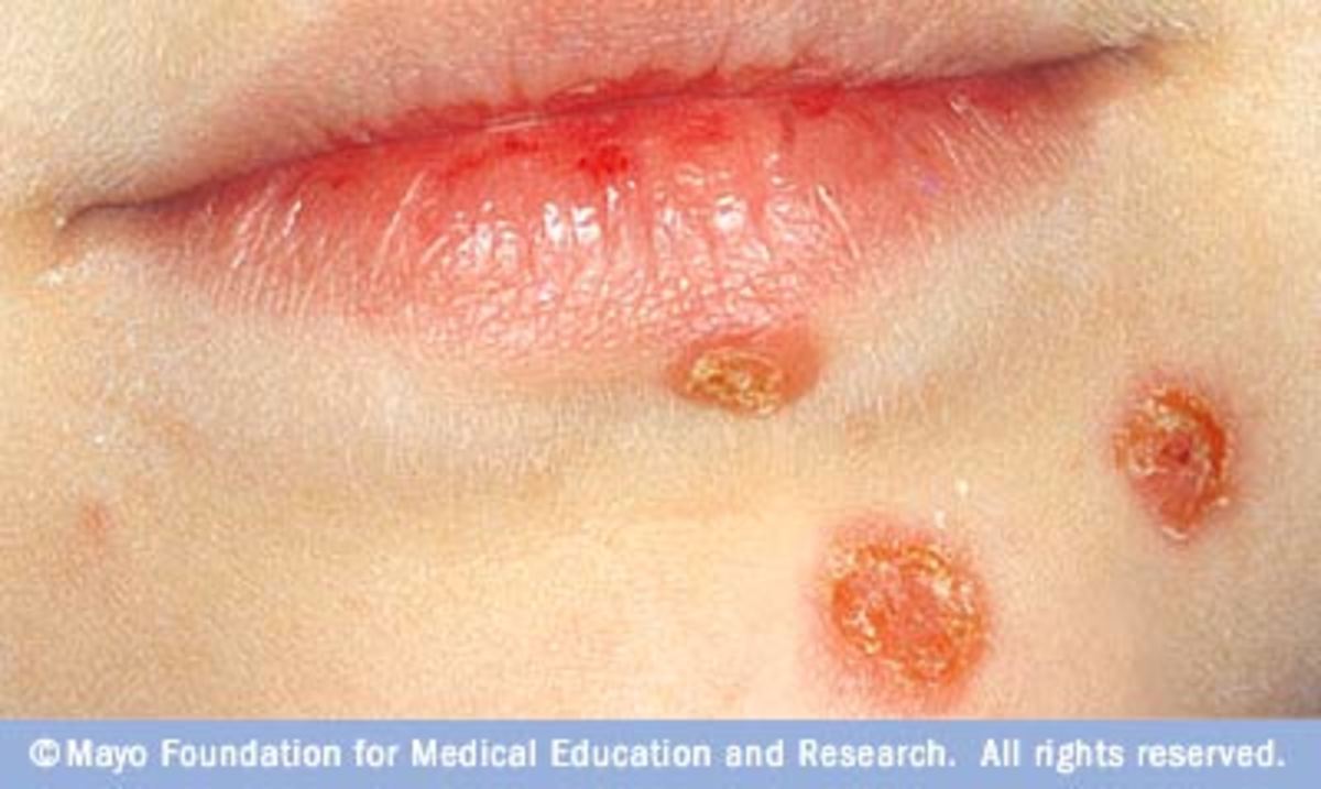 Early Stages of Impetigo or Staph in an infant.