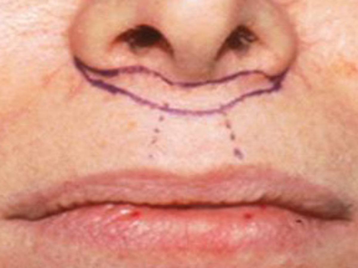 lip-enhancement-augmentation