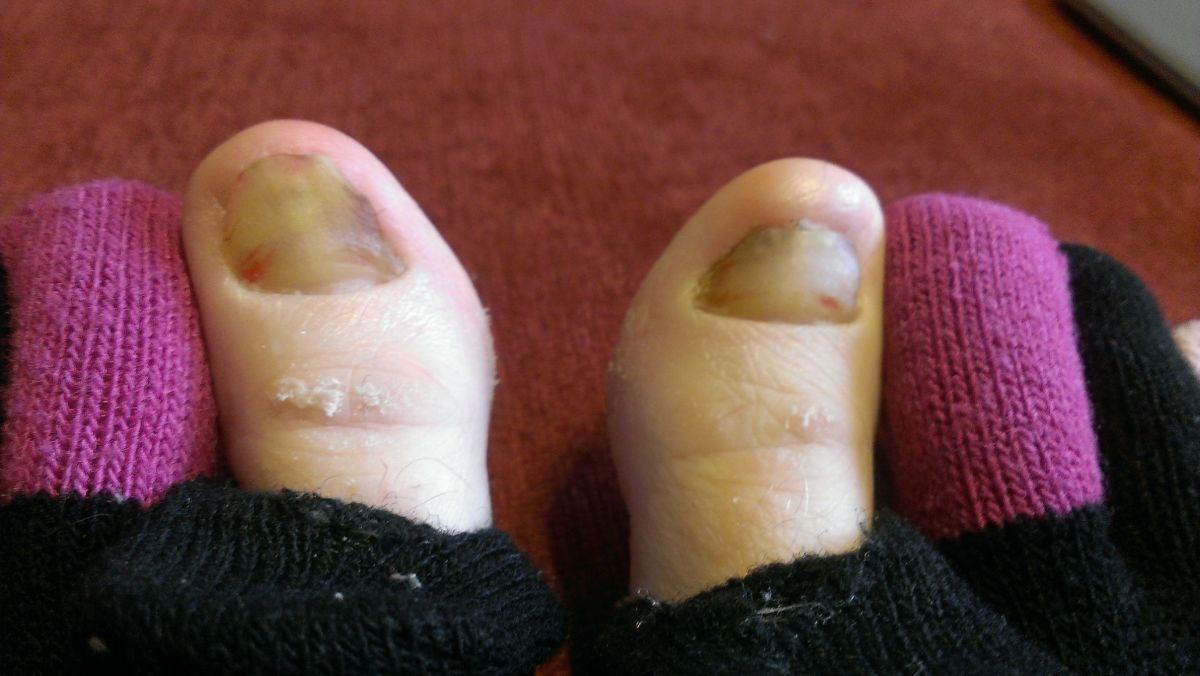 how-to-naturally-get-rid-of-toenail-fungus