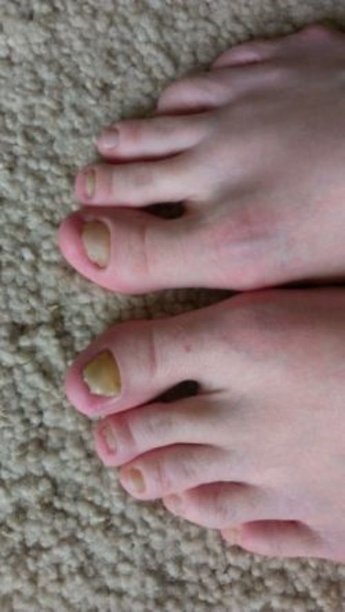 how-to-naturally-get-rid-of-toenail-fungus