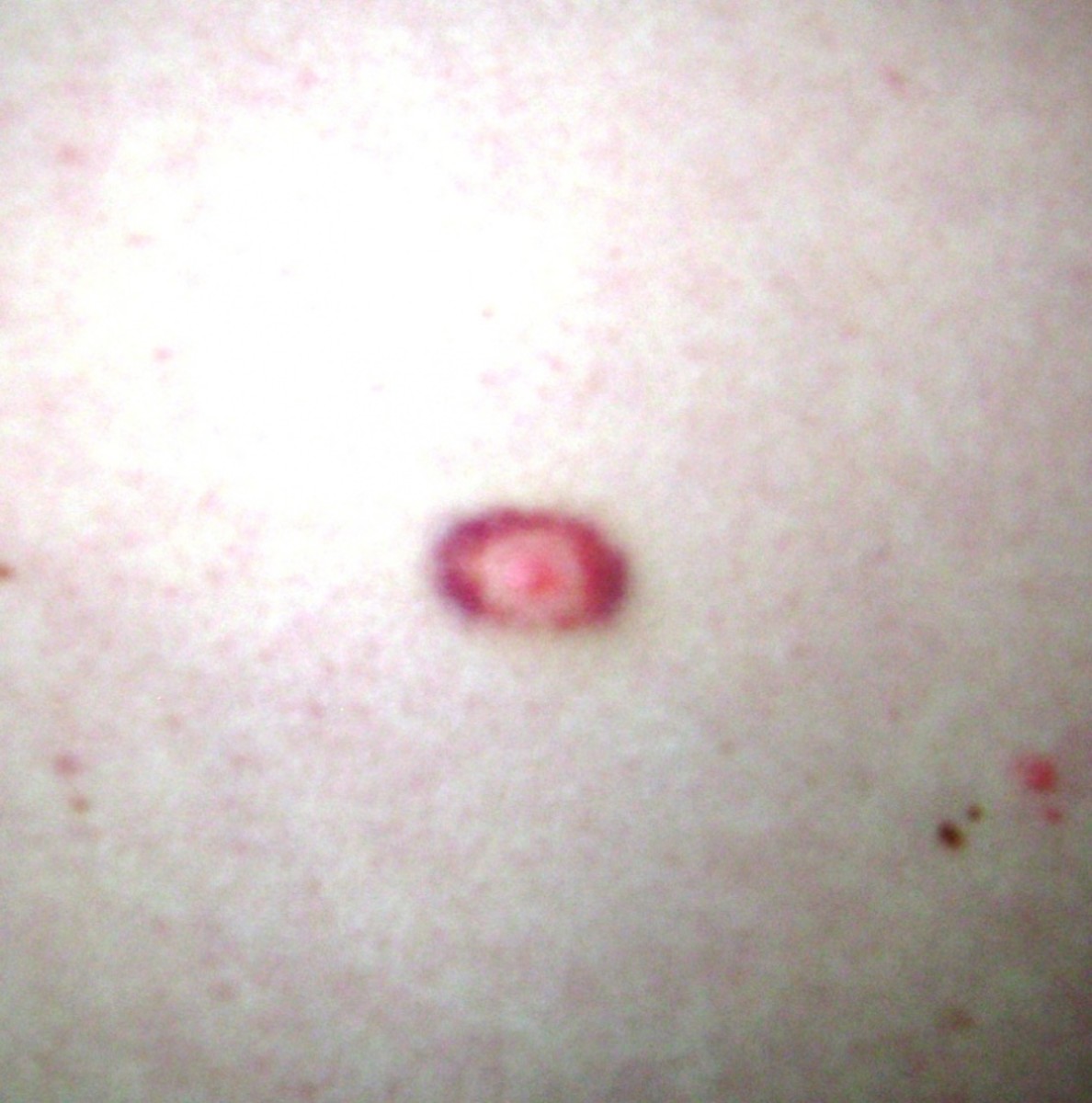 An example of a bulls eye rash on an individual in SW AR taken in October, 2011.  