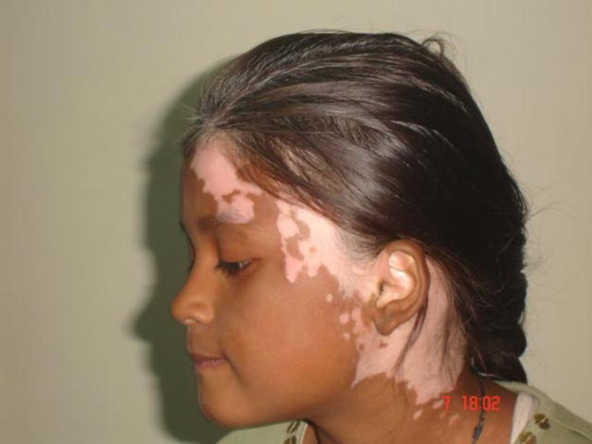 Vitiligo affecting facial skin