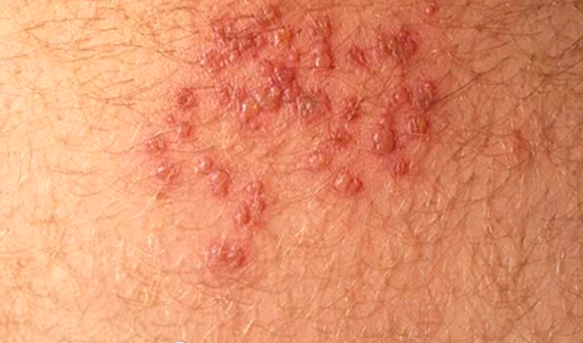 hiv-rash-pictures-life-expectancy-symptoms-treatment-cure