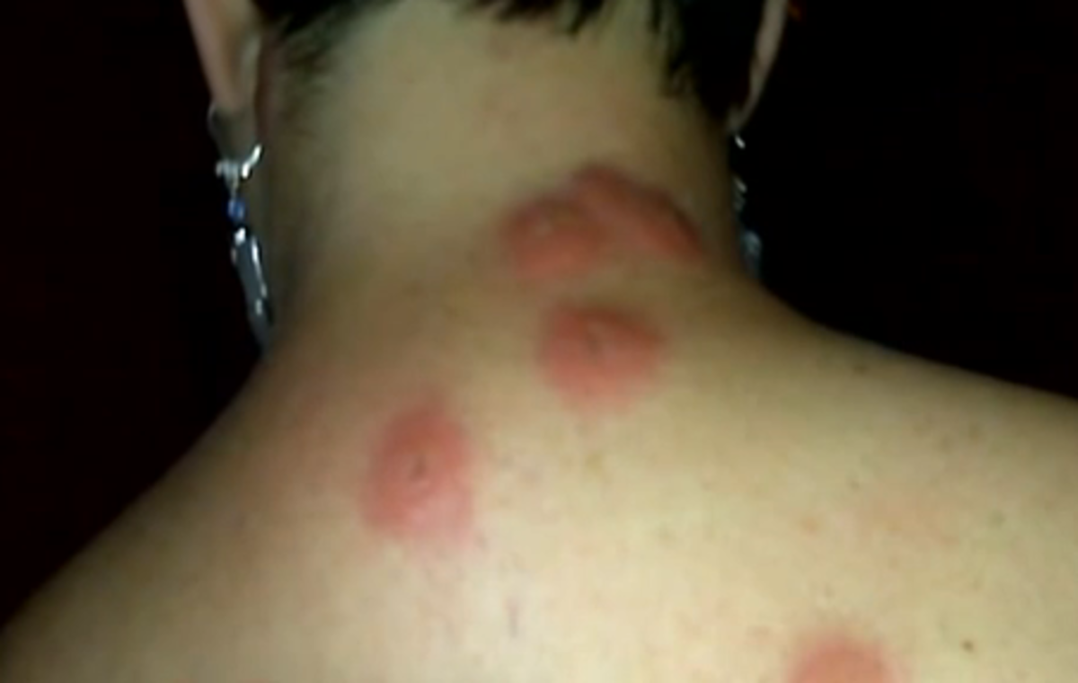 bed-bug-bites-pictures-symptoms-causes-treatment