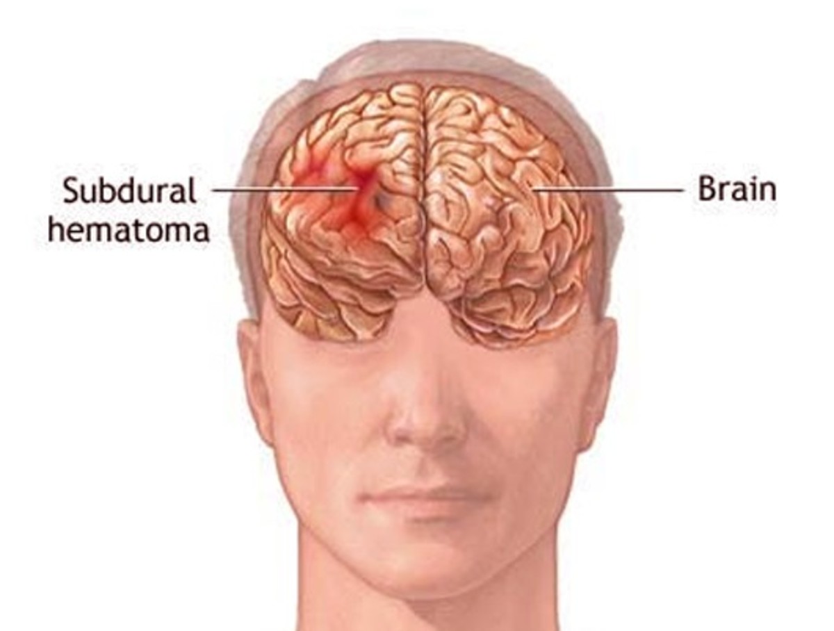 Сотрясение мозга гематома в мозгах