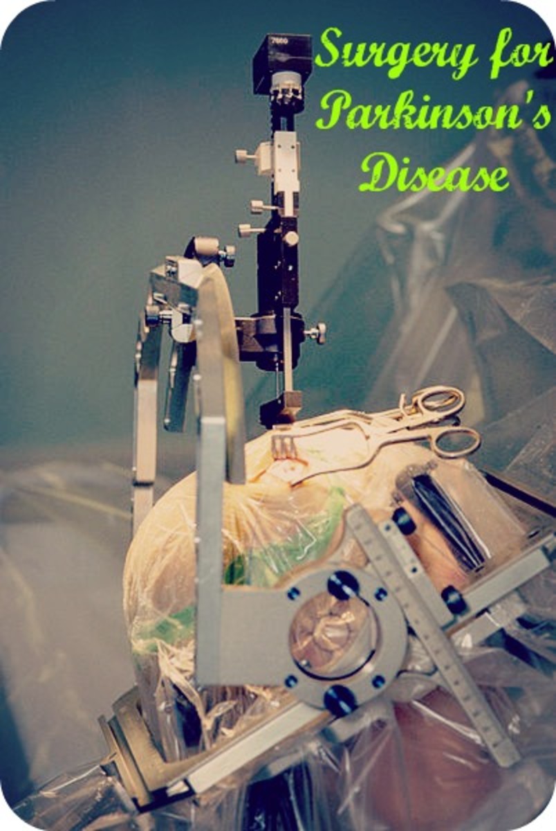 Multiple Choice Questions on Parkinson’s Disease HubPages