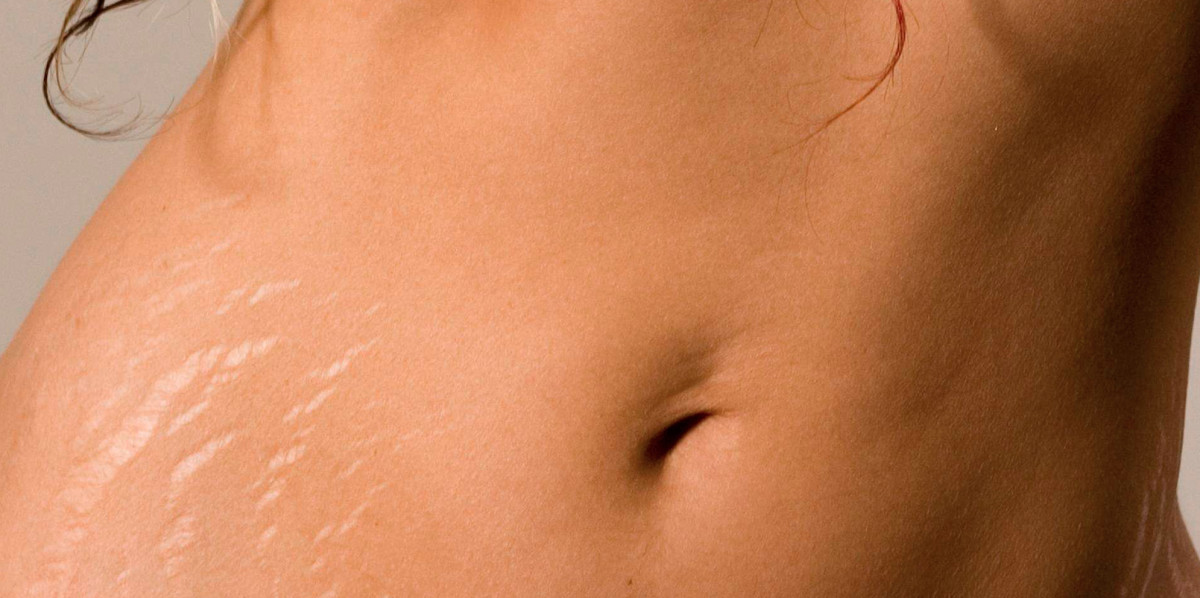 Best treatments and skin care products to eliminate stretch marks