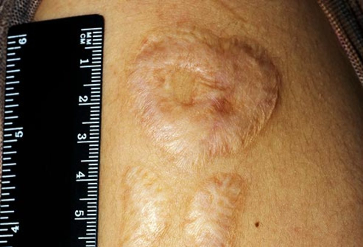 A scar after tattoo removal