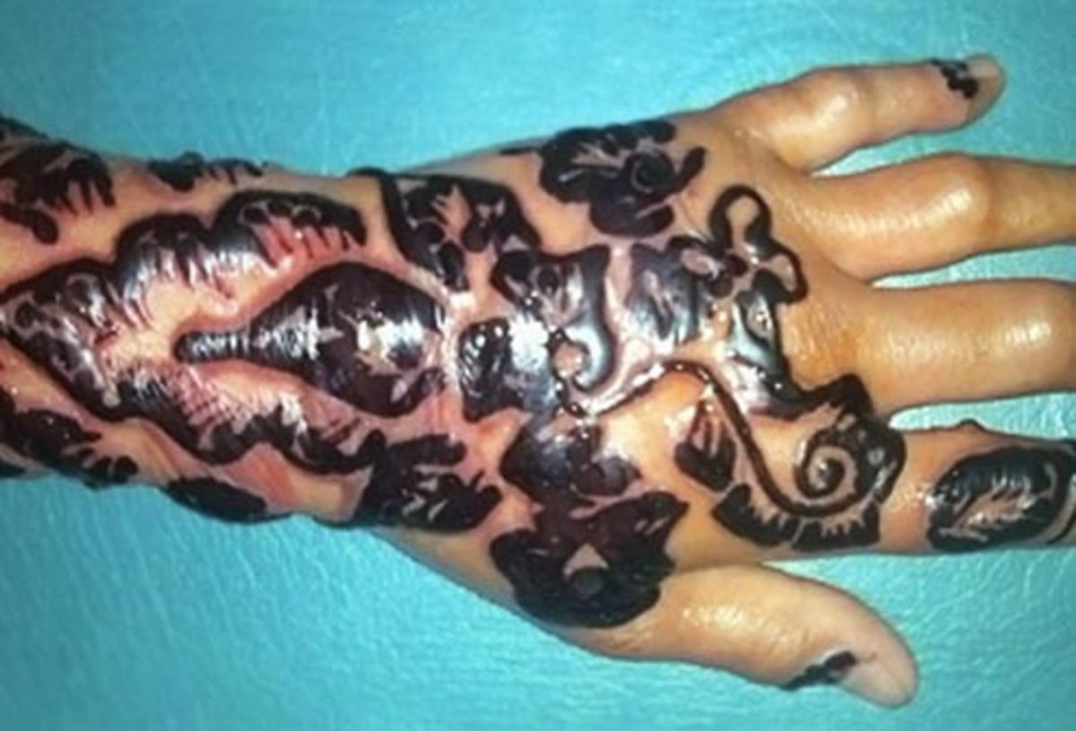 Tattoo with swelling and redness caused by red pigments
