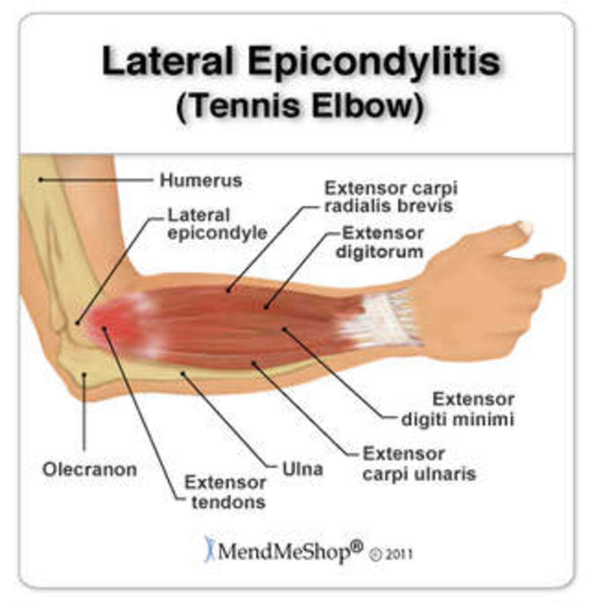 lateral-epicondylitis-elbow-pain-diagnosis-treatment-and-outcomes